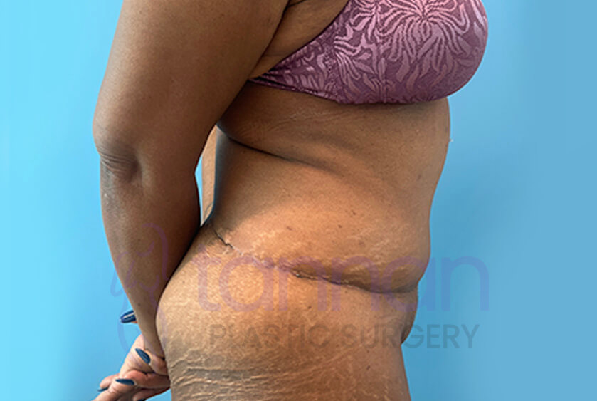 Fleur De Lis Abdominoplasty side view after - Tannan Plastic Surgery
