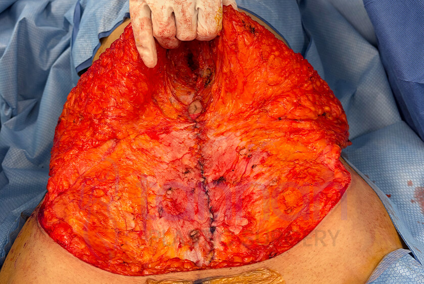 Diastasis repair after photo - Tannan Plastic Surgery