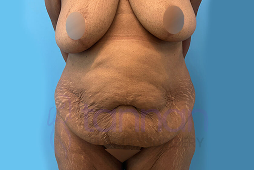 Fleur De Lis Abdominoplasty front view before - Tannan Plastic Surgery