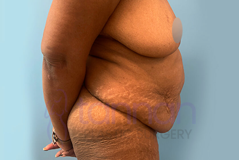 Fleur De Lis Abdominoplasty side view before - Tannan Plastic Surgery