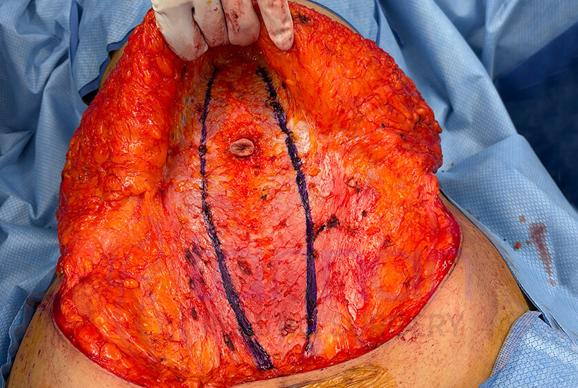 Diastasis repair before photo - Tannan Plastic Surgery